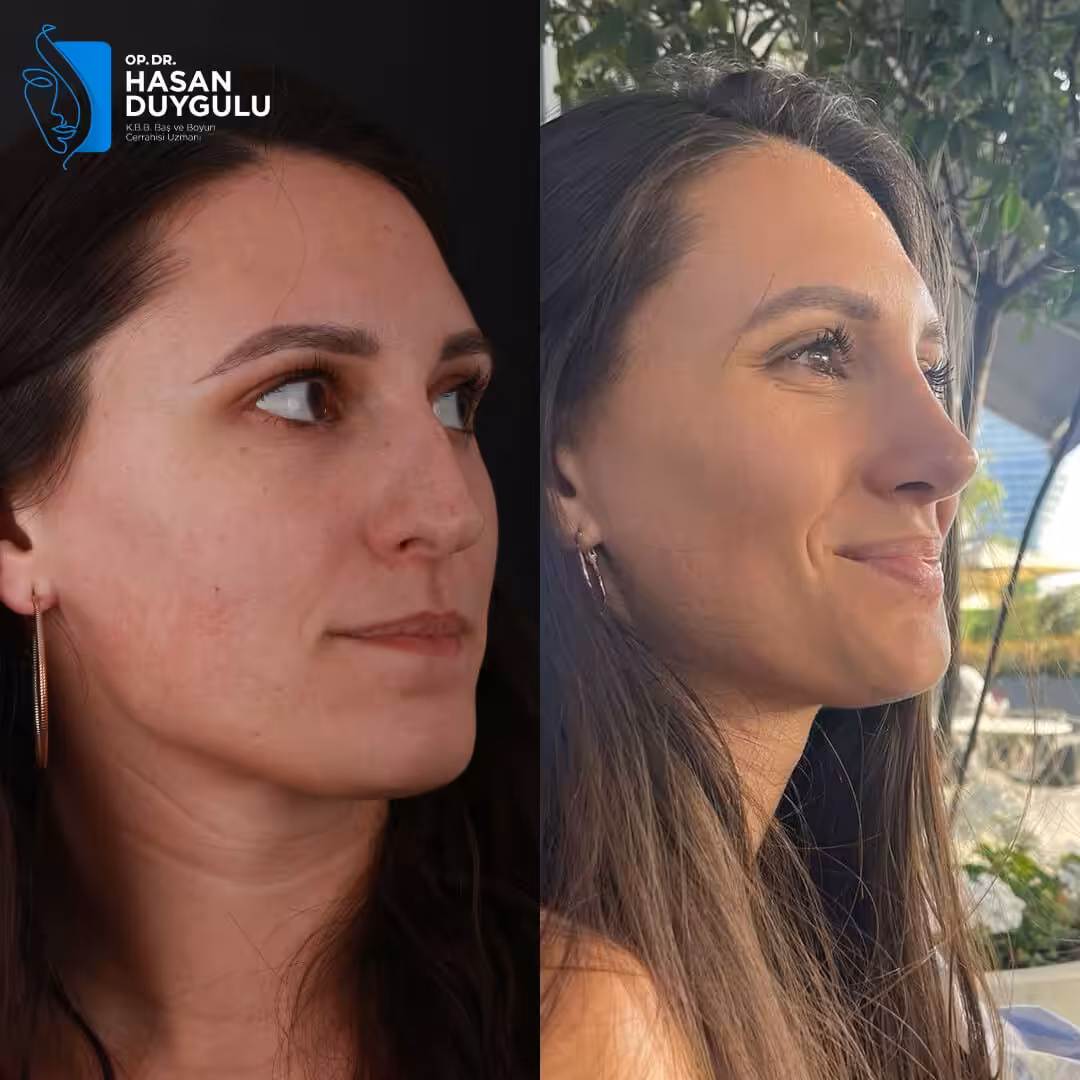 Rhinoplasty 4