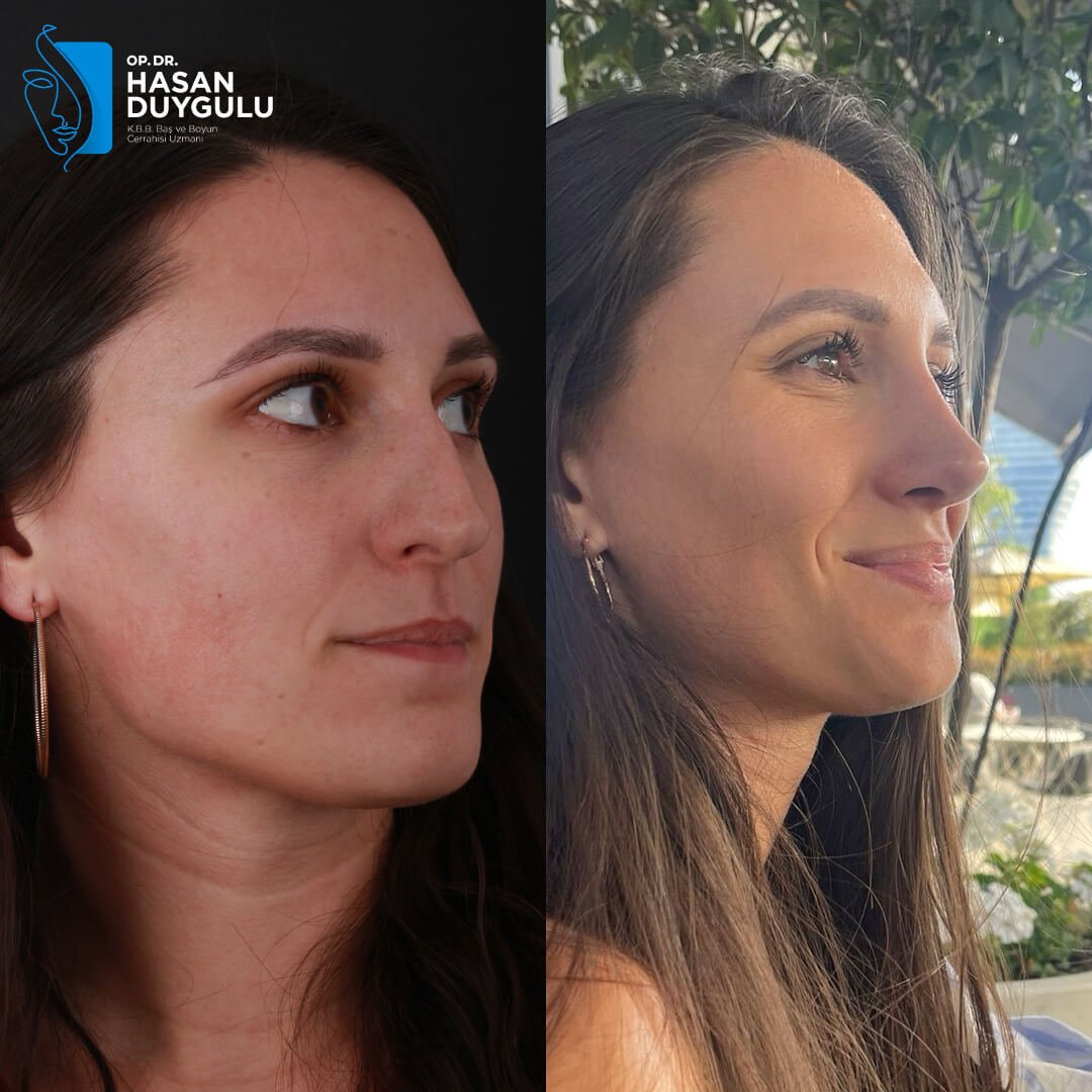 Rhinoplasty Turkey Gallery