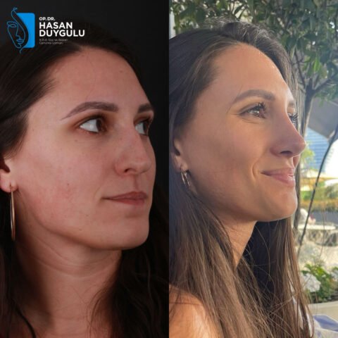 rhinoplasty-surgery-turkey