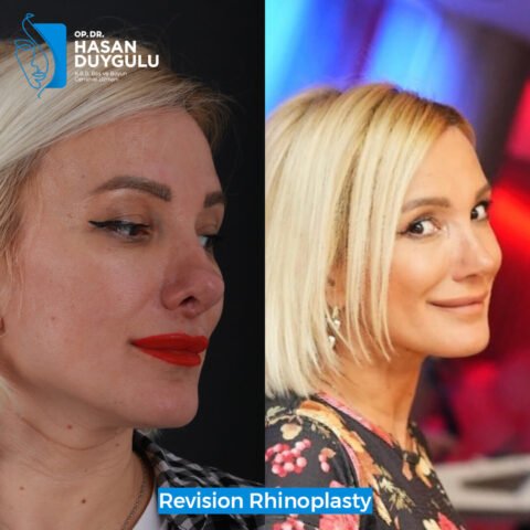 rhinoplasty-surgery-turkey-istanbul