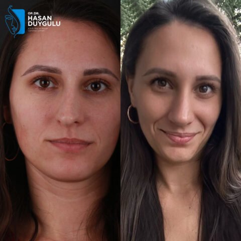 rhinoplasty-surgery-turkey-ıstanbul
