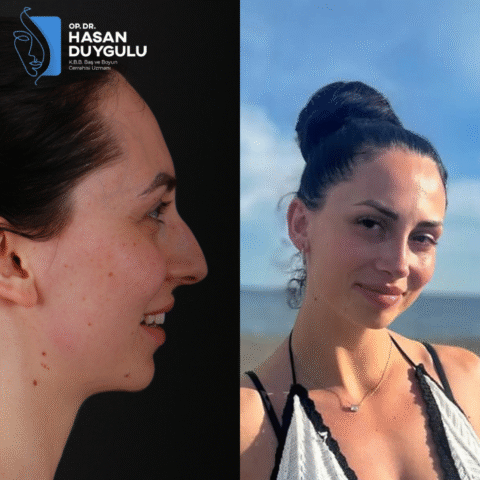 rhinoplasty-before-and-after