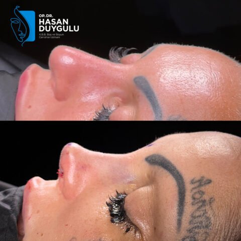 rhinoplasty-turkey