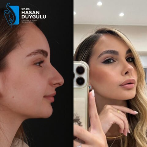 rhinoplasty-job-turkey