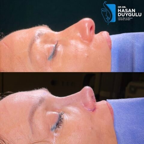 rhinoplasty-surgeon-turkey