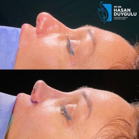rhinoplasty-turkey