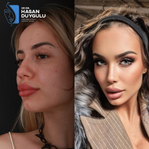 rhinoplasty-surgeon-turkey