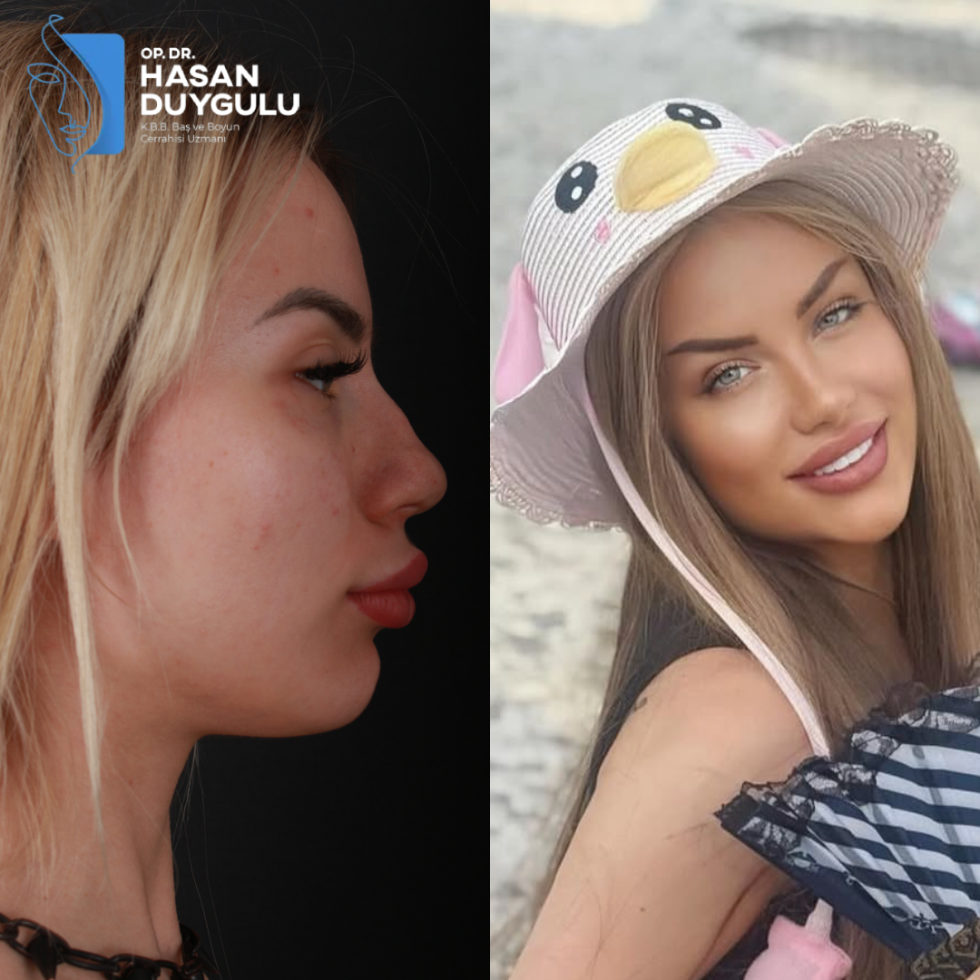 rhinoplasty-surgery