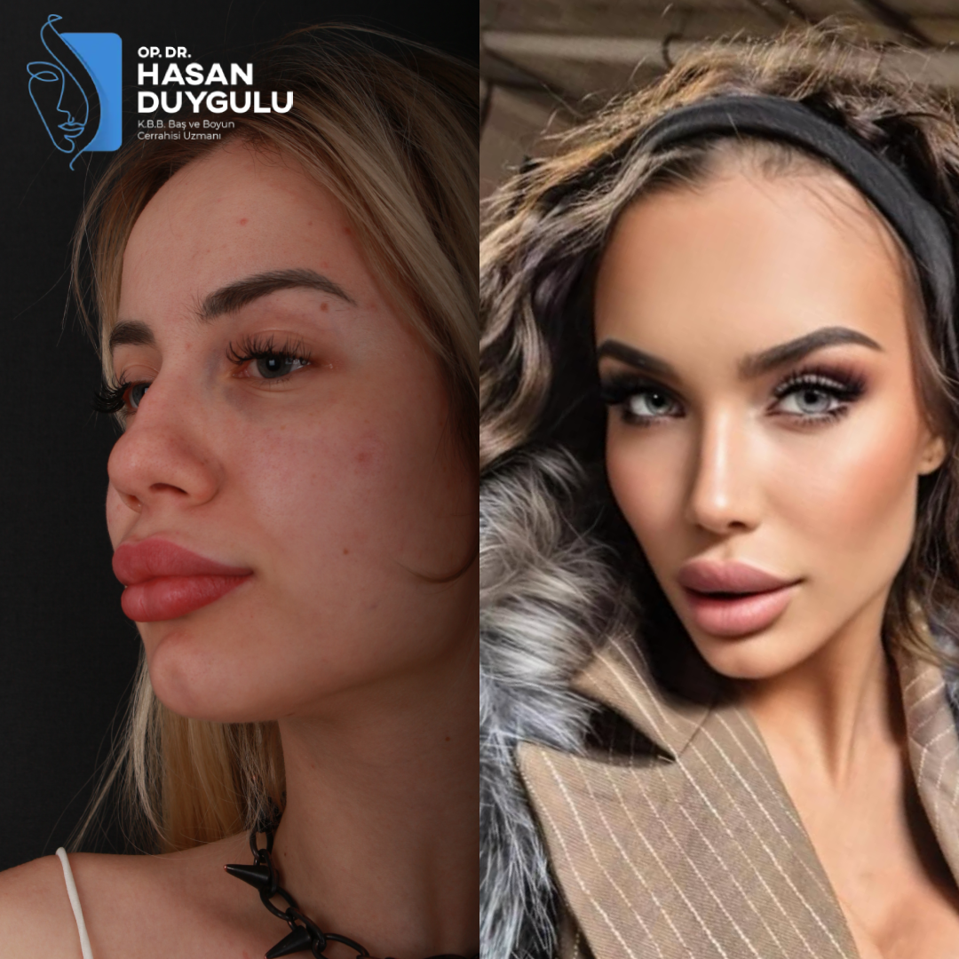 rhinoplasty-surgery-turkey