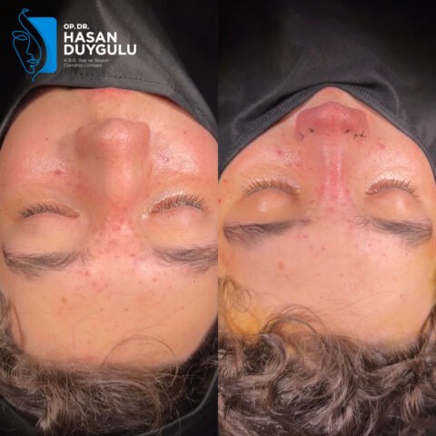 rhinoplasty-surgery-in-turkey