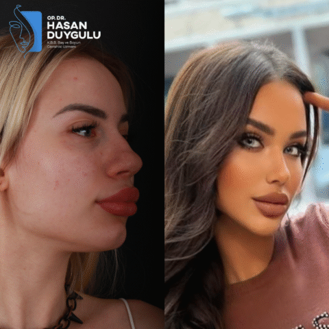 rhinoplasty-surgery-in-turkey