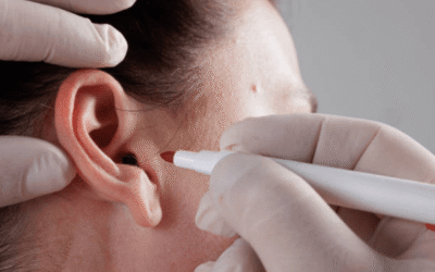 Otoplasty Surgery in Turkey (Ear Aesthetics)