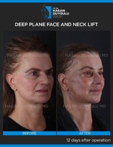 Neck Lift Turkey Gallery & Before and After Photos