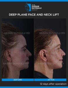 Neck Lift Turkey Gallery & Before and After Photos