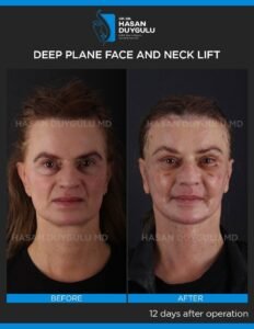Neck Lift Turkey Gallery & Before and After Photos