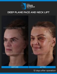 Neck Lift Turkey Gallery & Before and After Photos