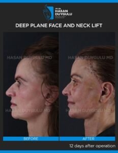 Neck Lift Turkey Gallery & Before and After Photos