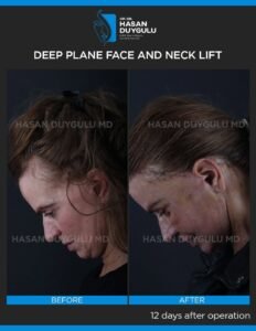 Neck Lift Turkey Gallery & Before and After Photos