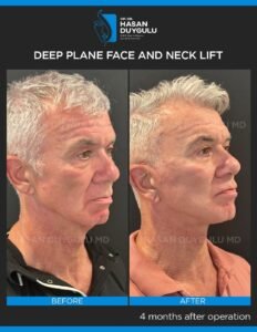 Neck Lift Turkey Gallery & Before and After Photos
