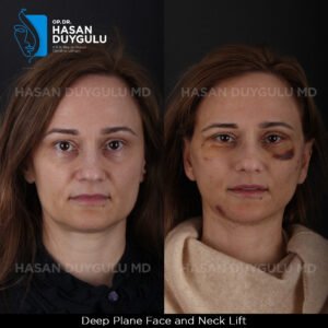 Facelift Before After Photos in Turkey