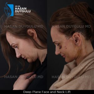 Facelift Before After Photos in Turkey