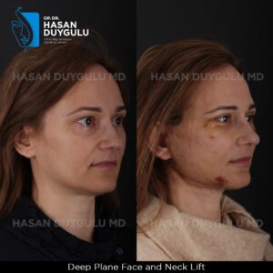 Facelift Before After Photos in Turkey
