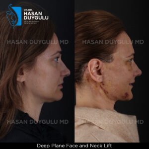 Facelift Before After Photos in Turkey