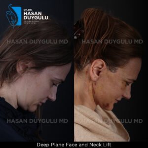 Facelift Before After Photos in Turkey