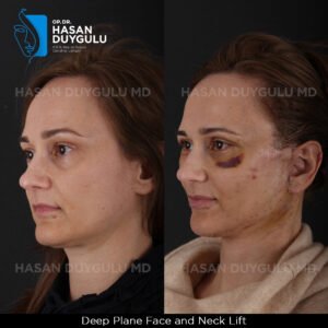 Facelift Before After Photos in Turkey