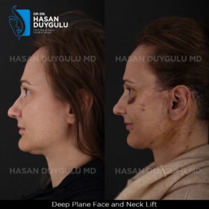 Facelift Before After Photos in Turkey