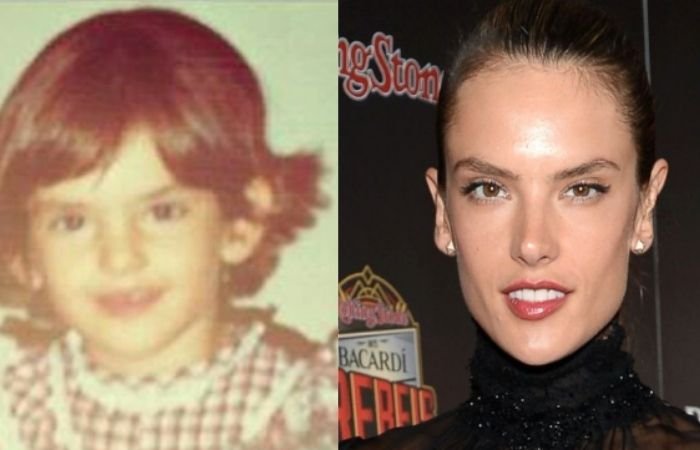 14 Celebrities With Otoplasty | Before & After Photos 14 Celebrities With Otoplasty | Before & After Photos