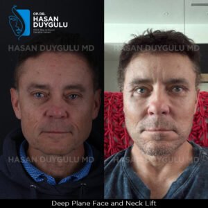 Facelift Before After Photos in Turkey