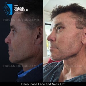 Facelift Before After Photos in Turkey