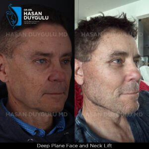 Facelift Before After Photos in Turkey