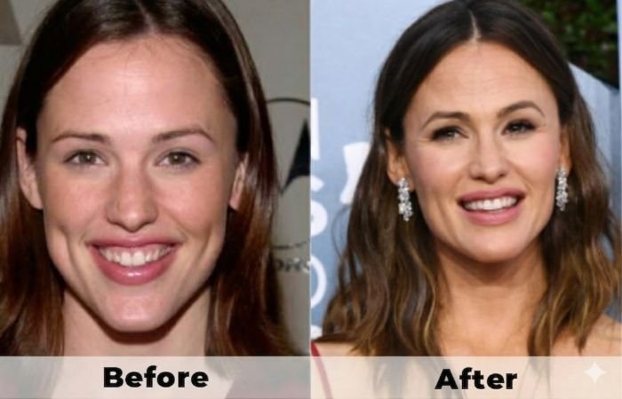 14 Celebrities With Otoplasty | Before & After Photos 14 Celebrities With Otoplasty | Before & After Photos