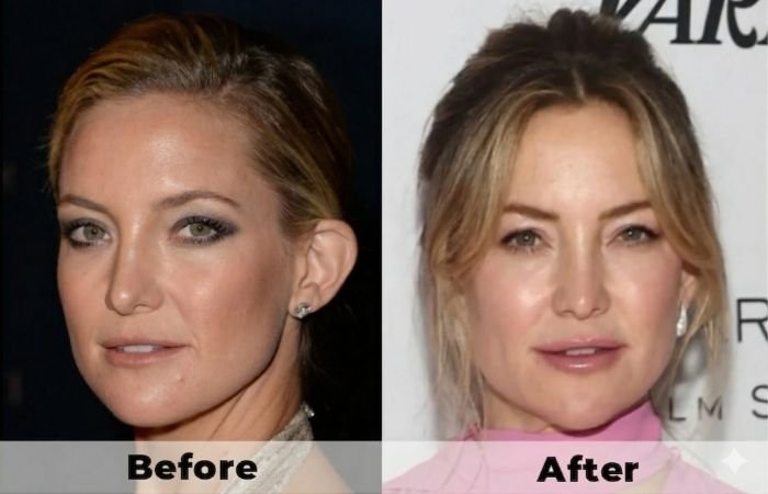 14 Celebrities With Otoplasty | Before & After Photos 14 Celebrities With Otoplasty | Before & After Photos