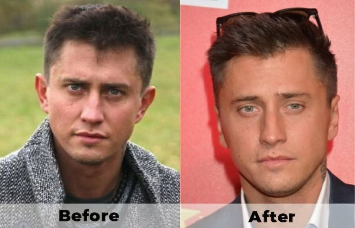 14 Celebrities With Otoplasty | Before & After Photos