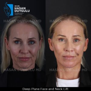 Facelift Before After Photos in Turkey