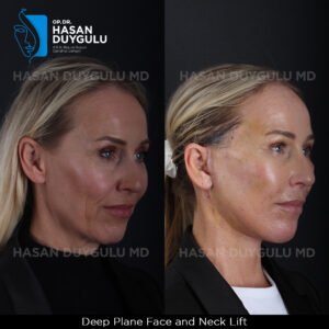 Facelift Before After Photos in Turkey