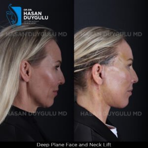 Facelift Before After Photos in Turkey