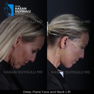 Facelift Before After Photos in Turkey
