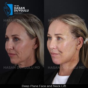 Facelift Before After Photos in Turkey