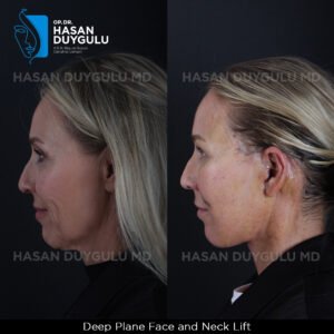 Facelift Before After Photos in Turkey