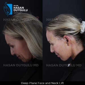Facelift Before After Photos in Turkey