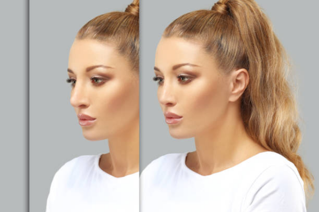 Revision Rhinoplasty in Turkey